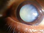cataract treatment in russia